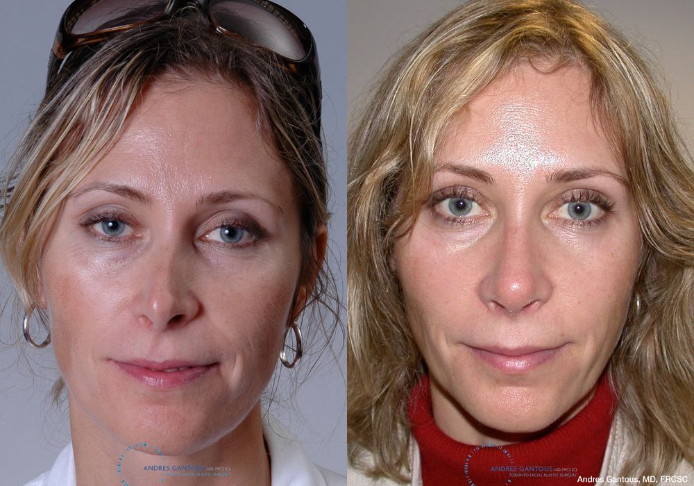 Revision Rhinoplasty - Case 6655