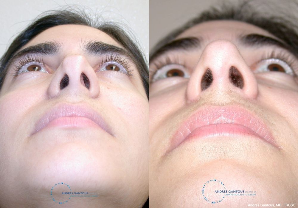 Revision Rhinoplasty - Thumbnail 2