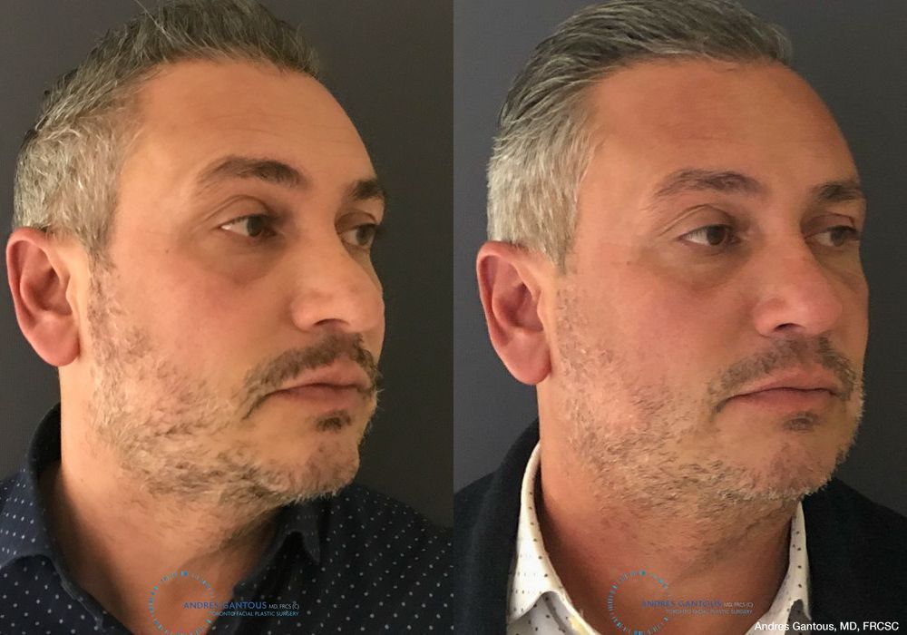 Revision Rhinoplasty - Thumbnail 3