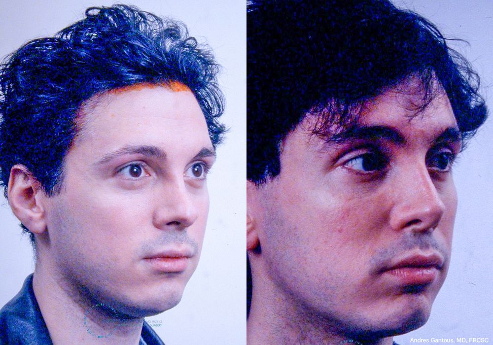 Revision Rhinoplasty - Thumbnail 2