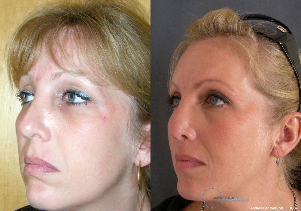 Revision Rhinoplasty - Thumbnail 4