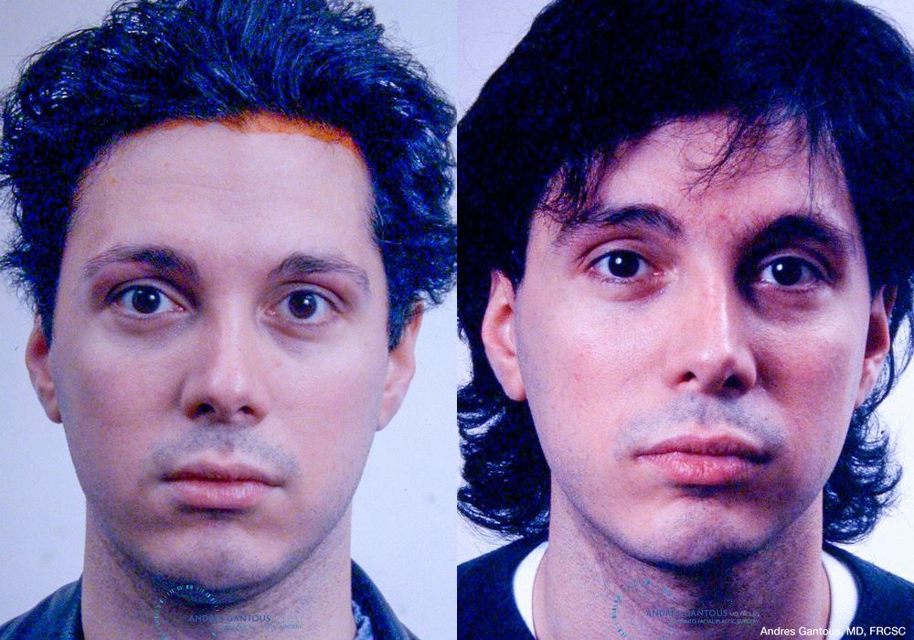 Revision Rhinoplasty - Case 6642