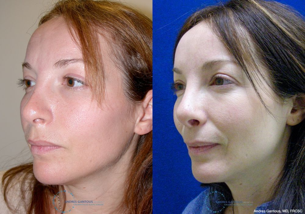 Revision Rhinoplasty - Thumbnail 3