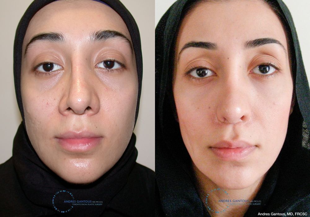 Revision Rhinoplasty - Case 7064