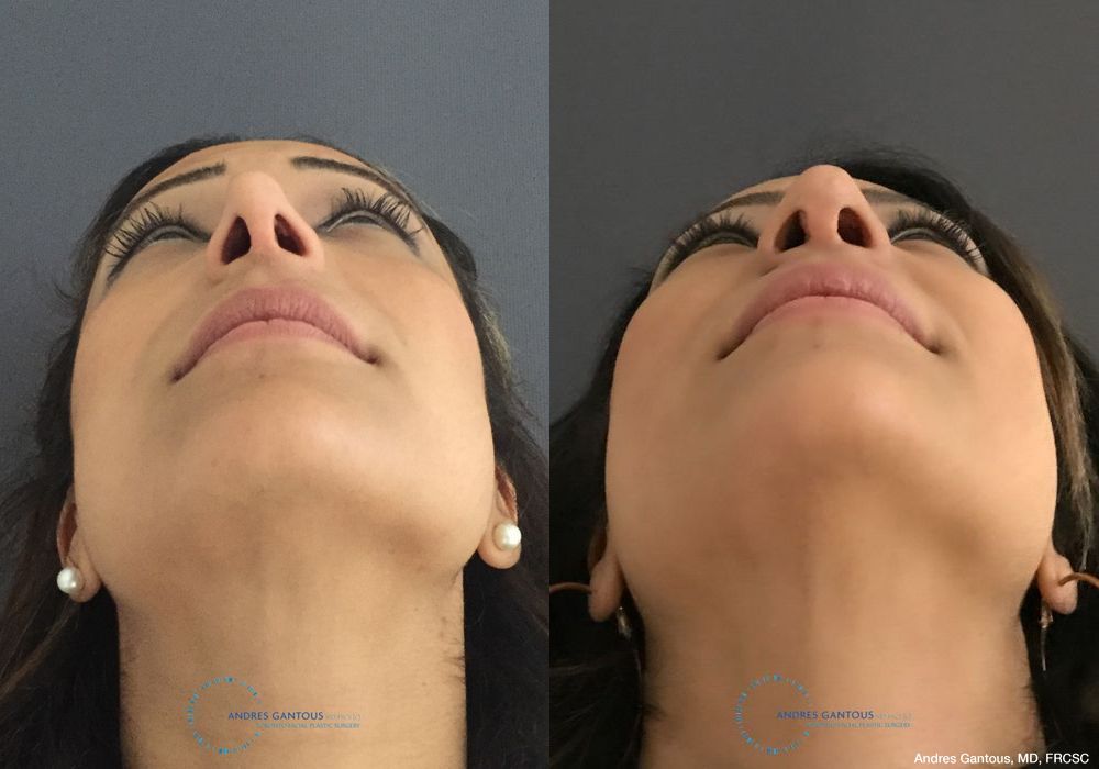 Revision Rhinoplasty - Thumbnail 2