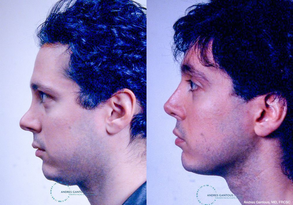 Revision Rhinoplasty - Thumbnail 5