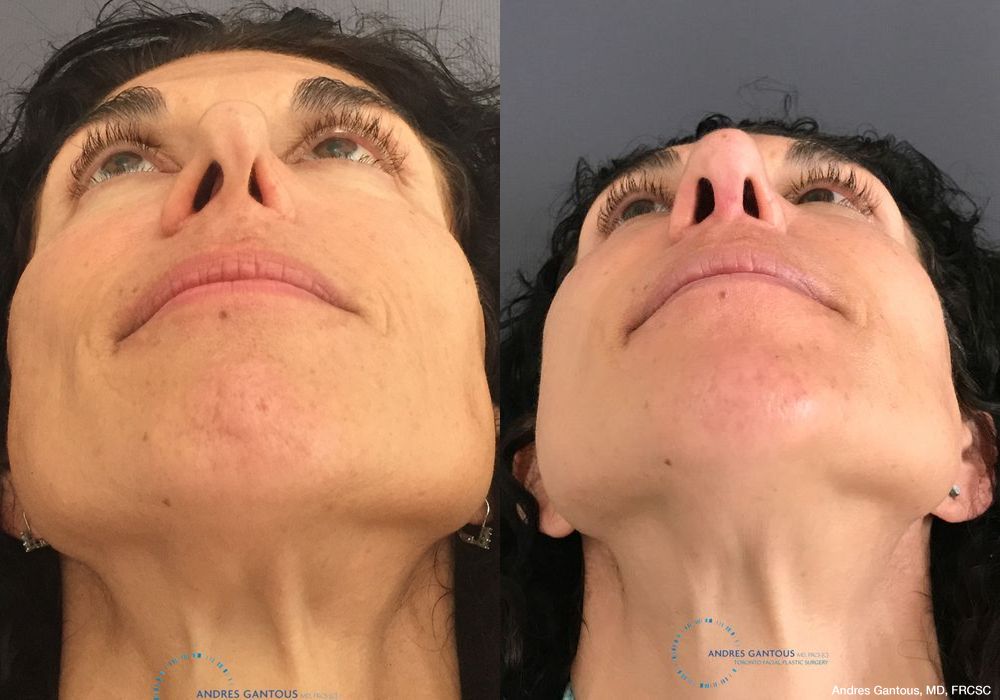 Revision Rhinoplasty - Thumbnail 2