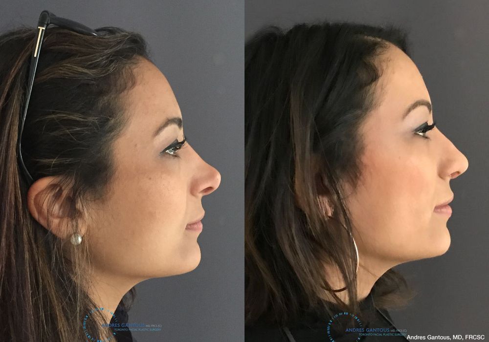 Revision Rhinoplasty - Thumbnail 5