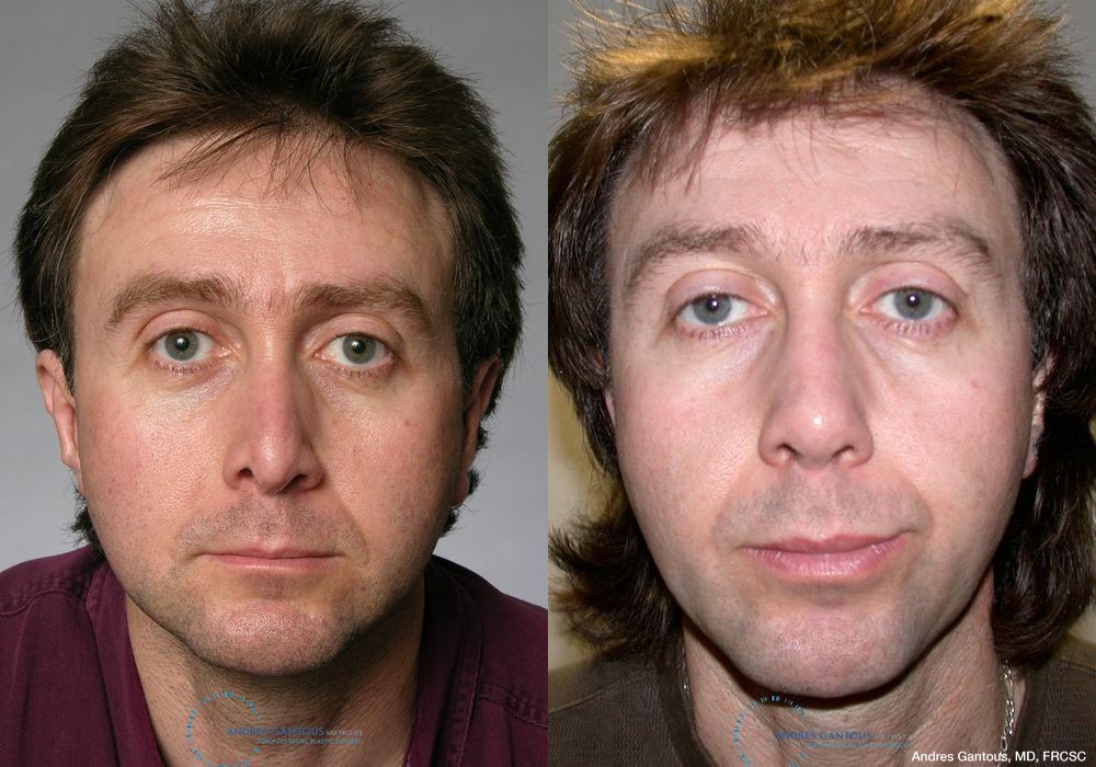 Revision Rhinoplasty - Case 6656