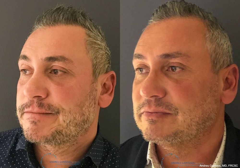 Revision Rhinoplasty - Thumbnail 4