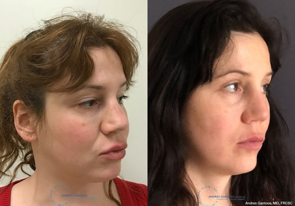 Revision Rhinoplasty - Thumbnail 3