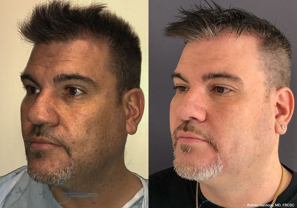 Revision Rhinoplasty - Thumbnail 3