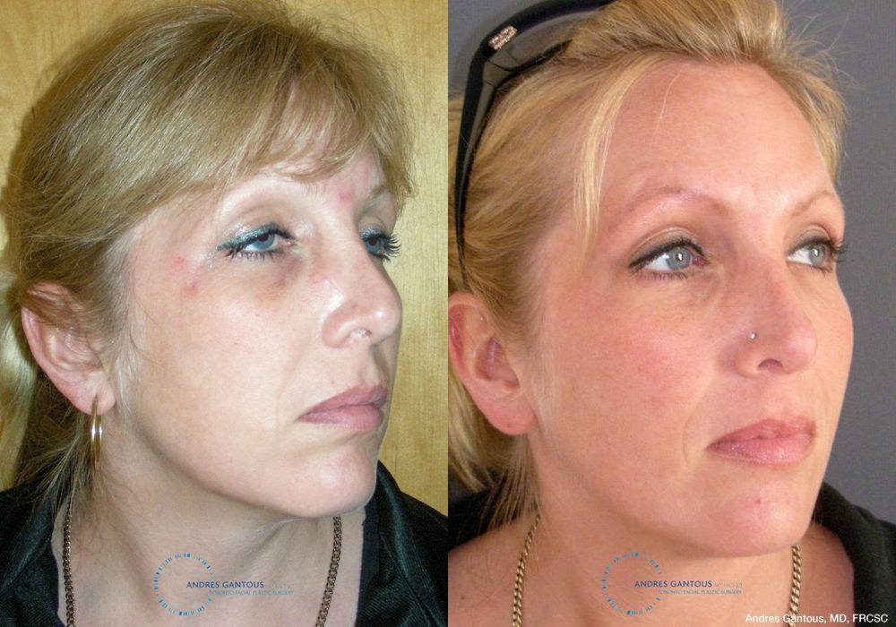 Revision Rhinoplasty - Thumbnail 3