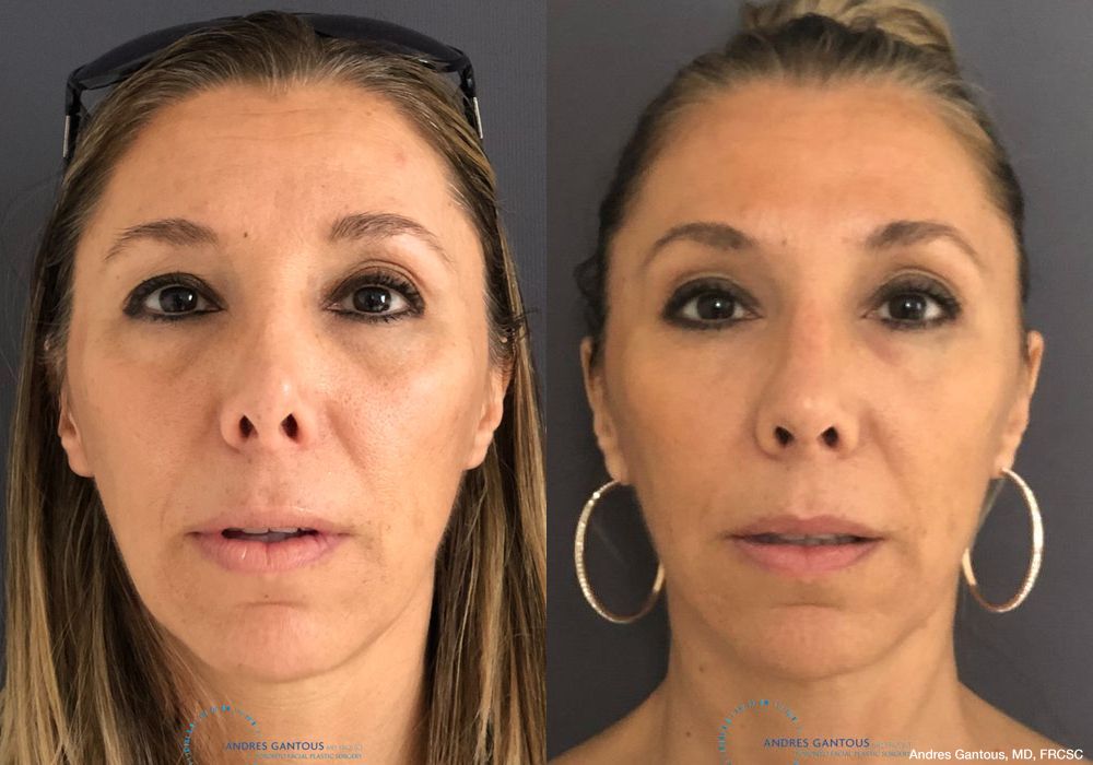 Revision Rhinoplasty - Case 6641