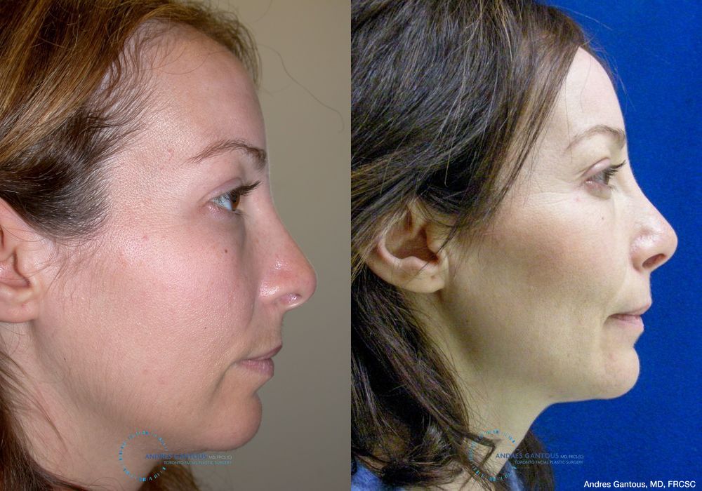 Revision Rhinoplasty - Thumbnail 4