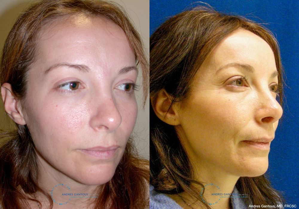 Revision Rhinoplasty - Thumbnail 2