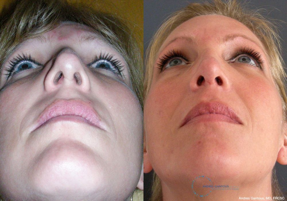 Revision Rhinoplasty - Thumbnail 2