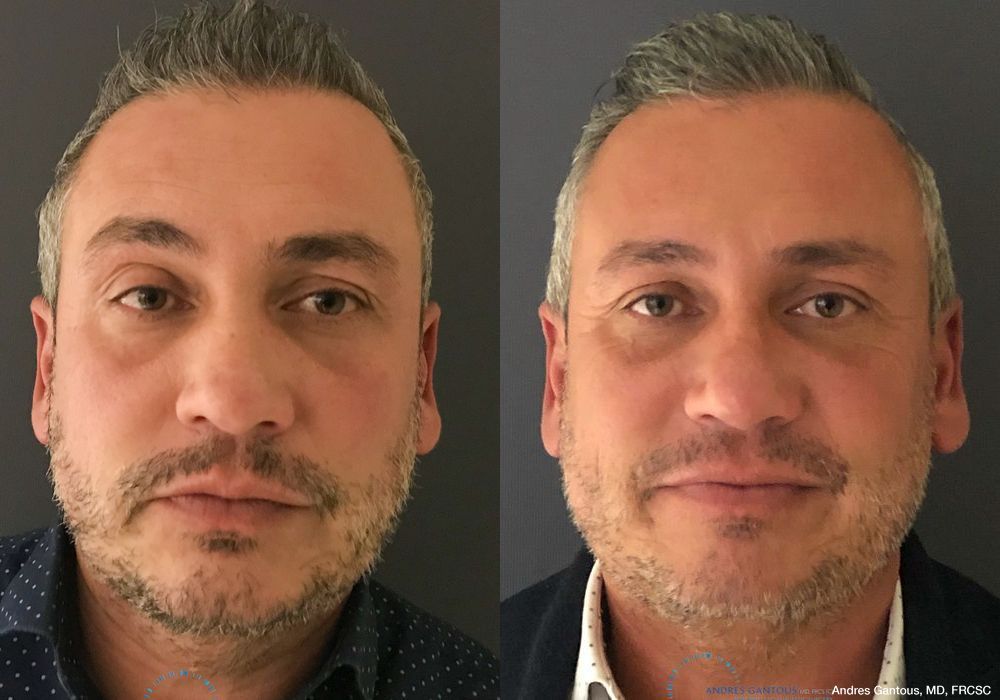 Revision Rhinoplasty - Case 6645