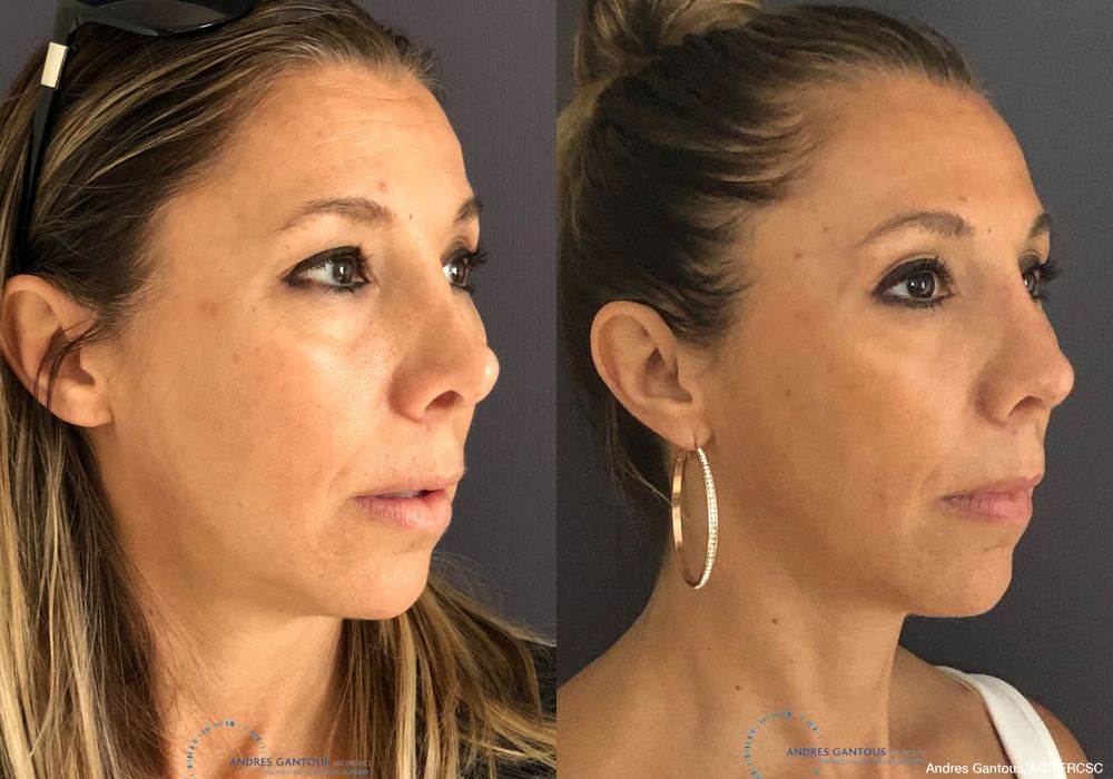 Revision Rhinoplasty - Thumbnail 4