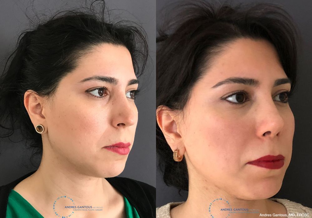 Revision Rhinoplasty - Thumbnail 4