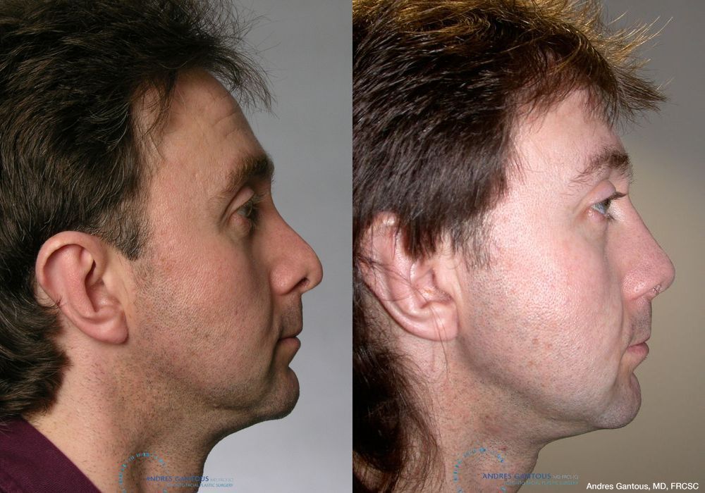 Revision Rhinoplasty - Thumbnail 3