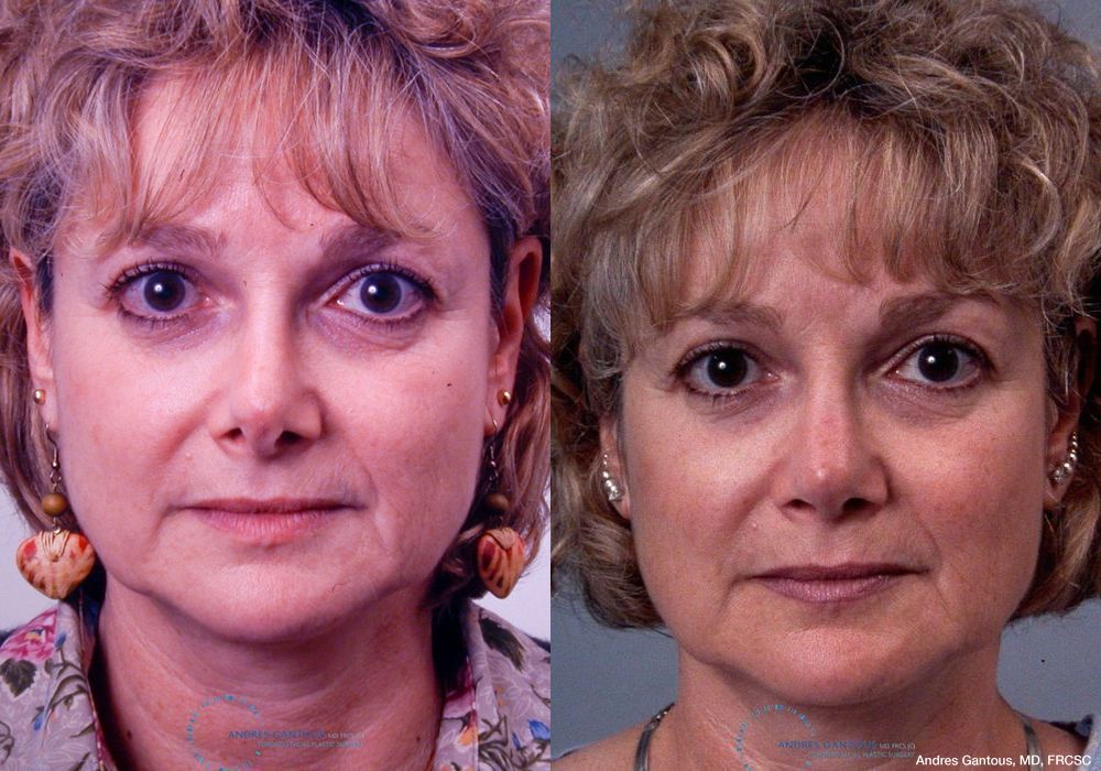 Revision Rhinoplasty - Case 6646