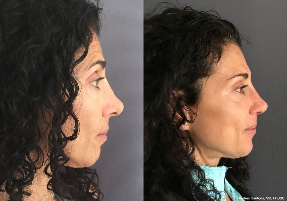 Revision Rhinoplasty - Thumbnail 6