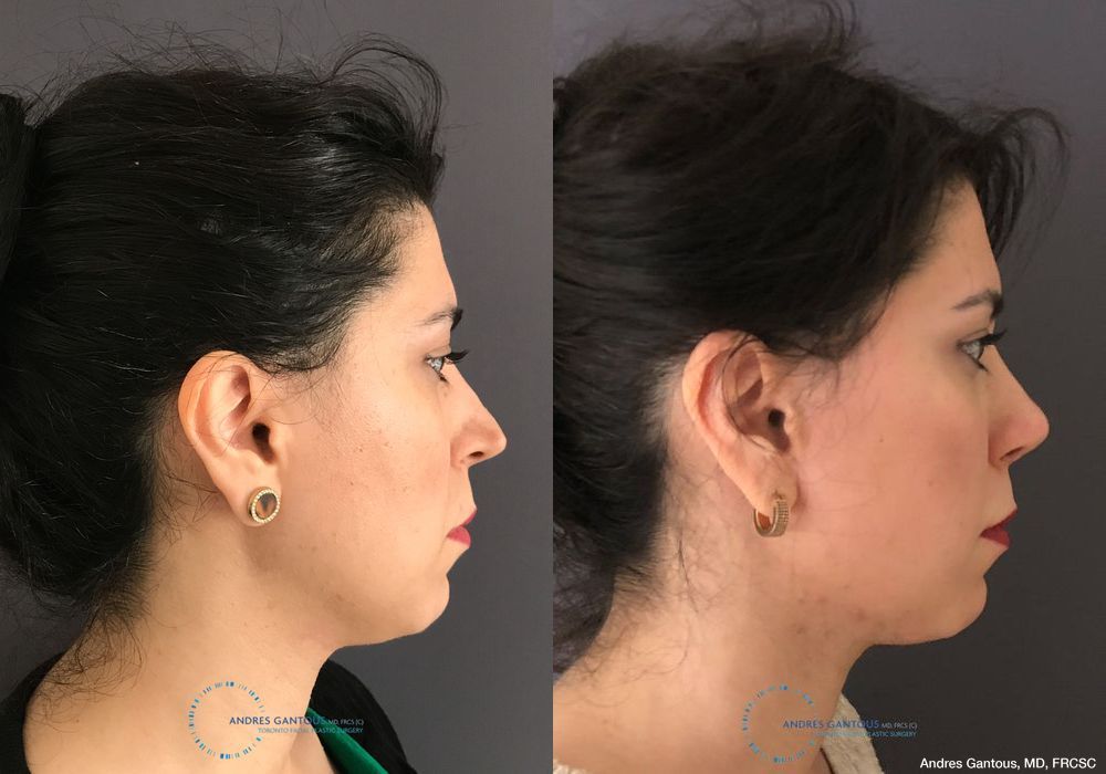 Revision Rhinoplasty - Thumbnail 5