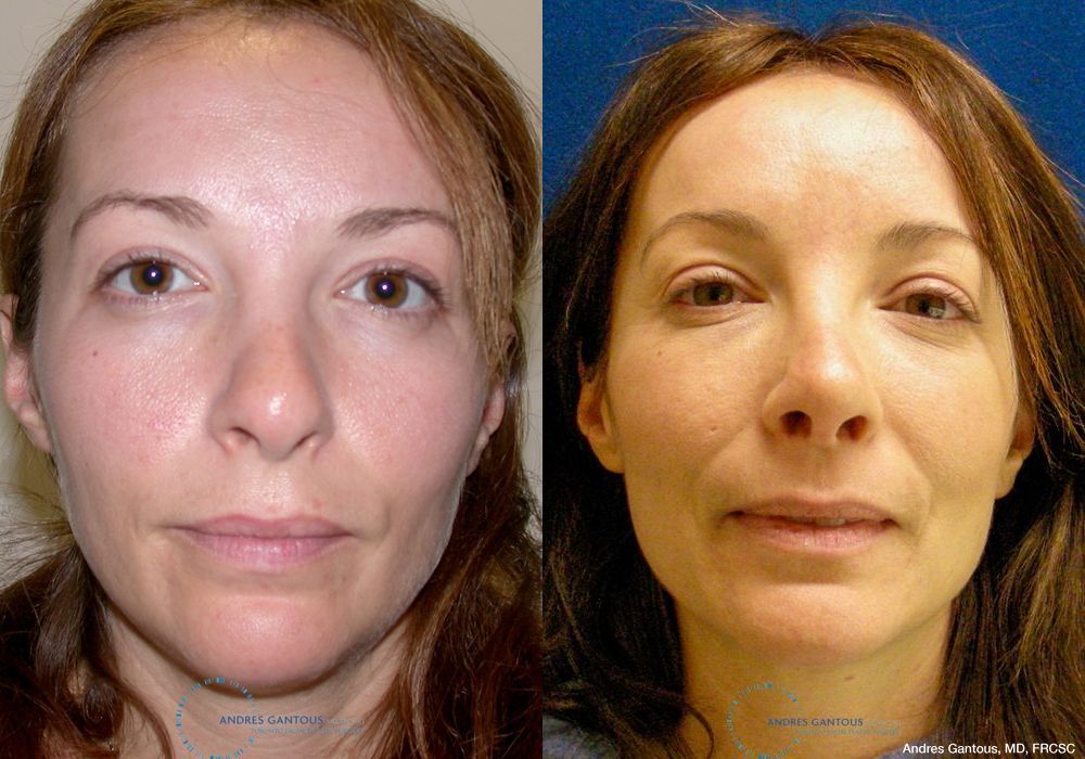 Revision Rhinoplasty - Case 6640