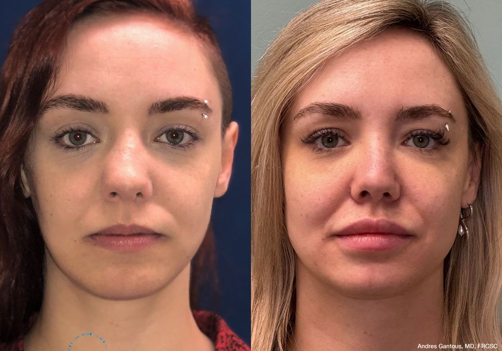 Revision Rhinoplasty - Case 7069