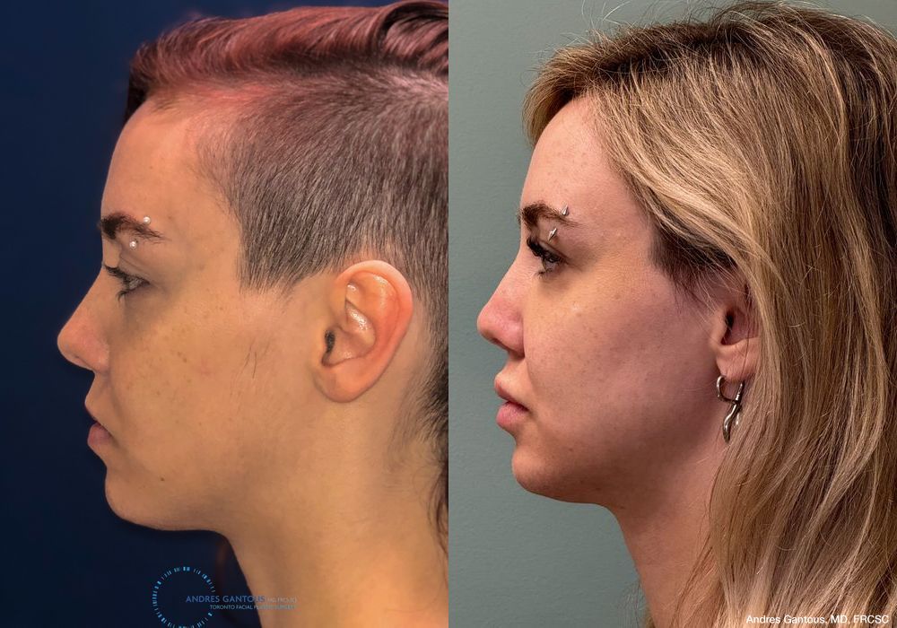 Revision Rhinoplasty - Thumbnail 5