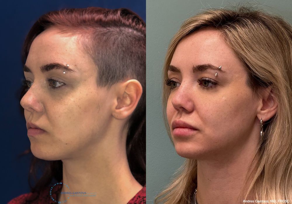 Revision Rhinoplasty - Thumbnail 3