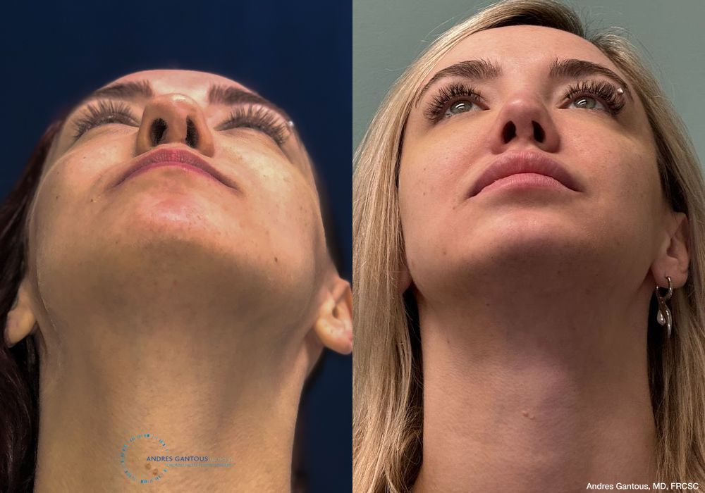 Revision Rhinoplasty - Thumbnail 2