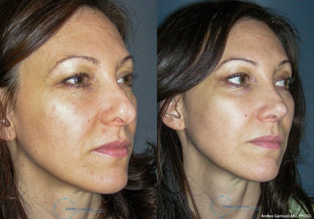 Revision Rhinoplasty - Thumbnail 3