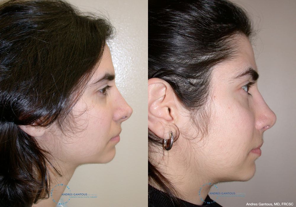 Revision Rhinoplasty - Thumbnail 6