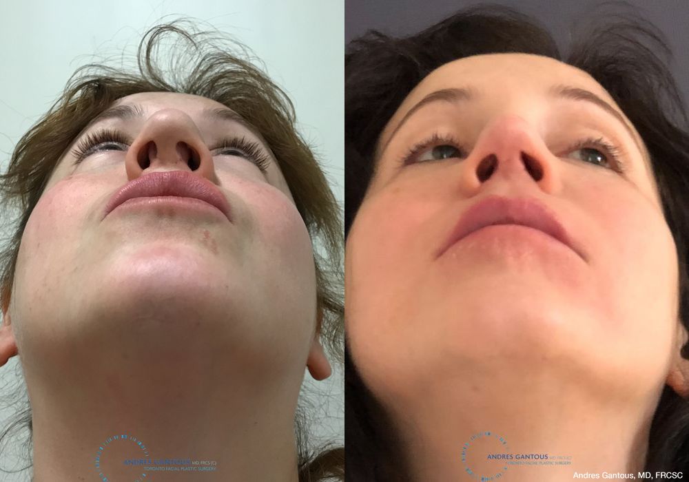 Revision Rhinoplasty - Thumbnail 2