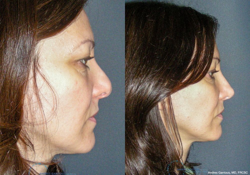 Revision Rhinoplasty - Thumbnail 5