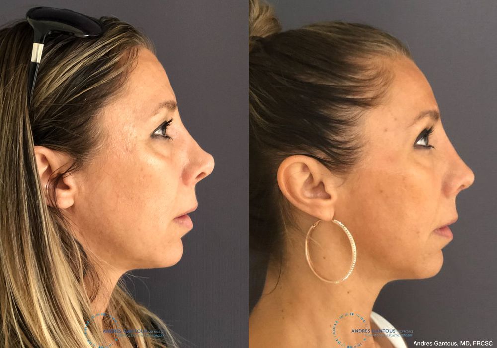 Revision Rhinoplasty - Thumbnail 5