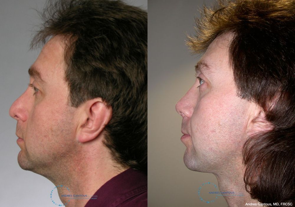 Revision Rhinoplasty - Thumbnail 4