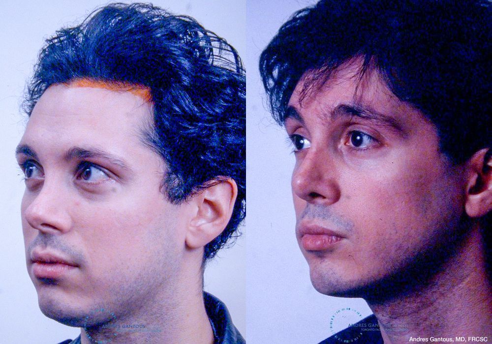 Revision Rhinoplasty - Thumbnail 3