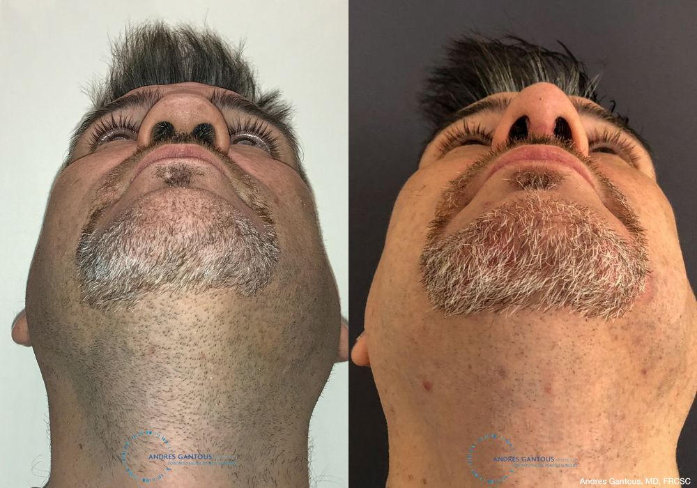 Revision Rhinoplasty - Thumbnail 2