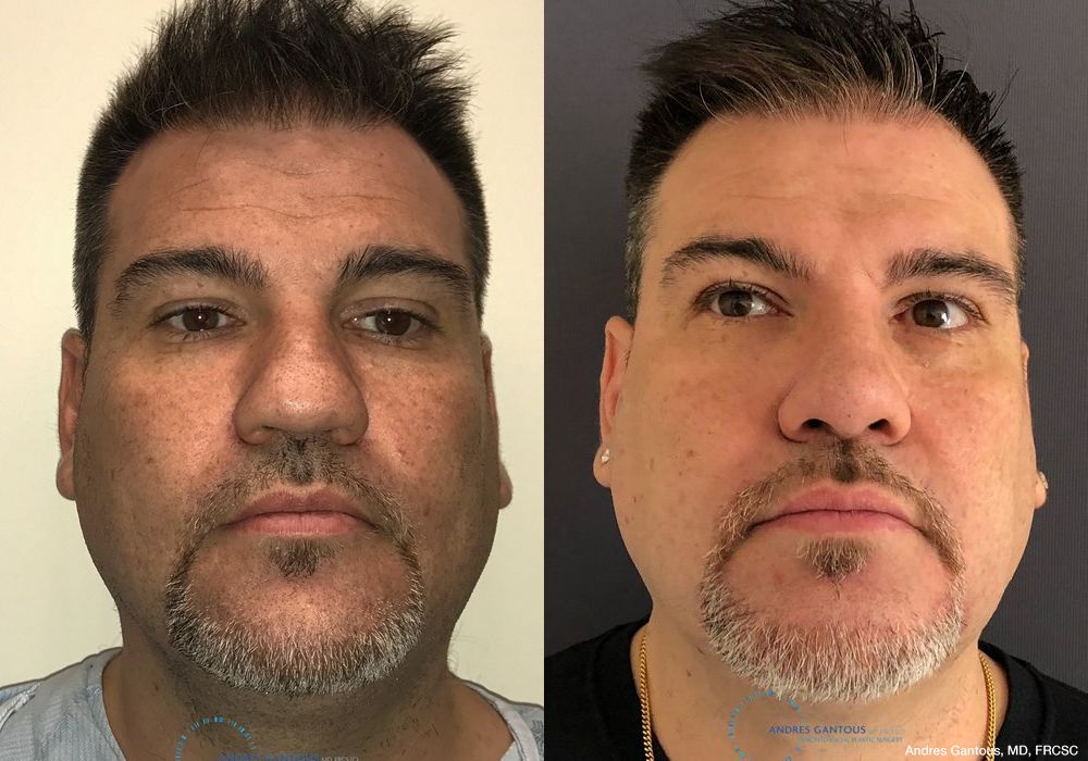 Revision Rhinoplasty - Case 6657