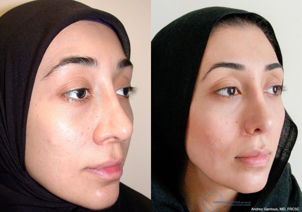 Revision Rhinoplasty - Thumbnail 3