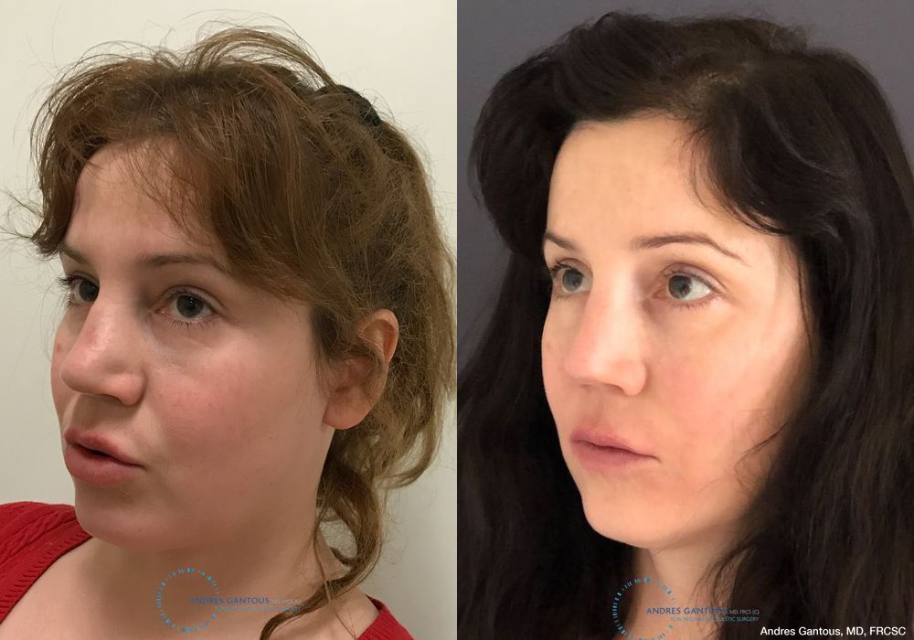 Revision Rhinoplasty - Thumbnail 4