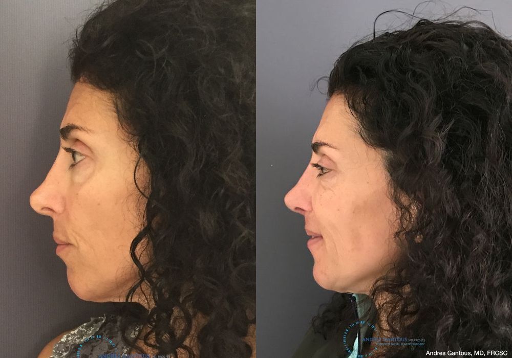 Revision Rhinoplasty - Thumbnail 5