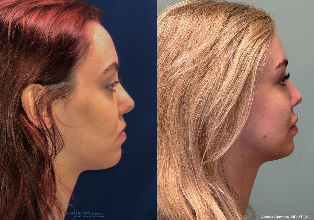 Revision Rhinoplasty - Thumbnail 6