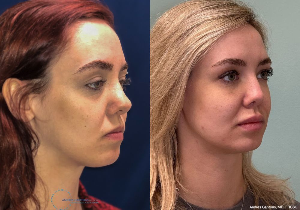 Revision Rhinoplasty - Thumbnail 4