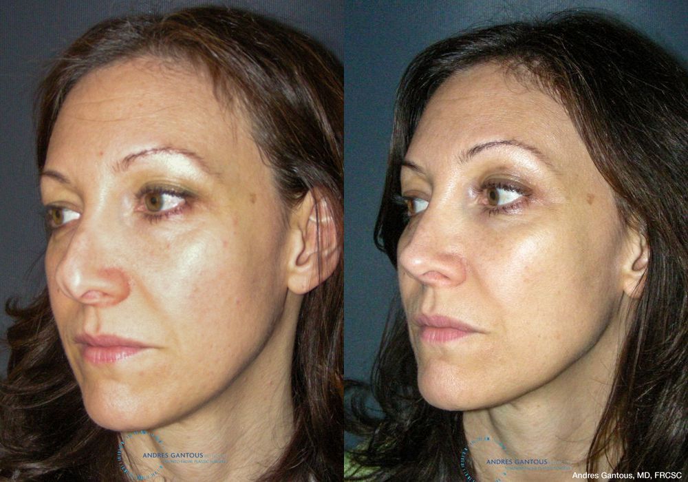 Revision Rhinoplasty - Thumbnail 4