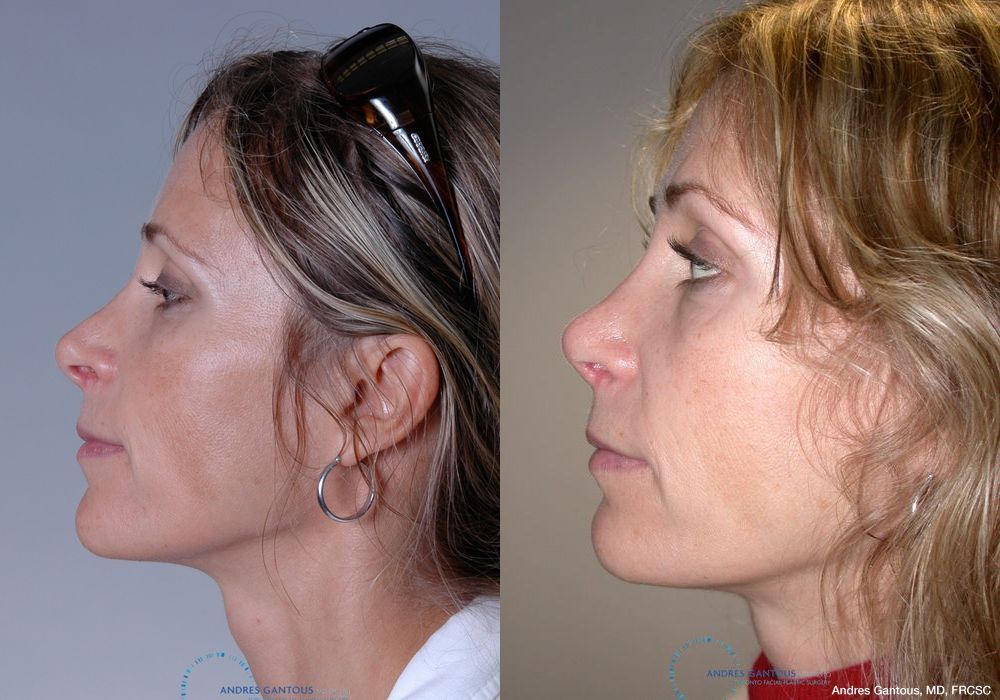 Revision Rhinoplasty - Thumbnail 4