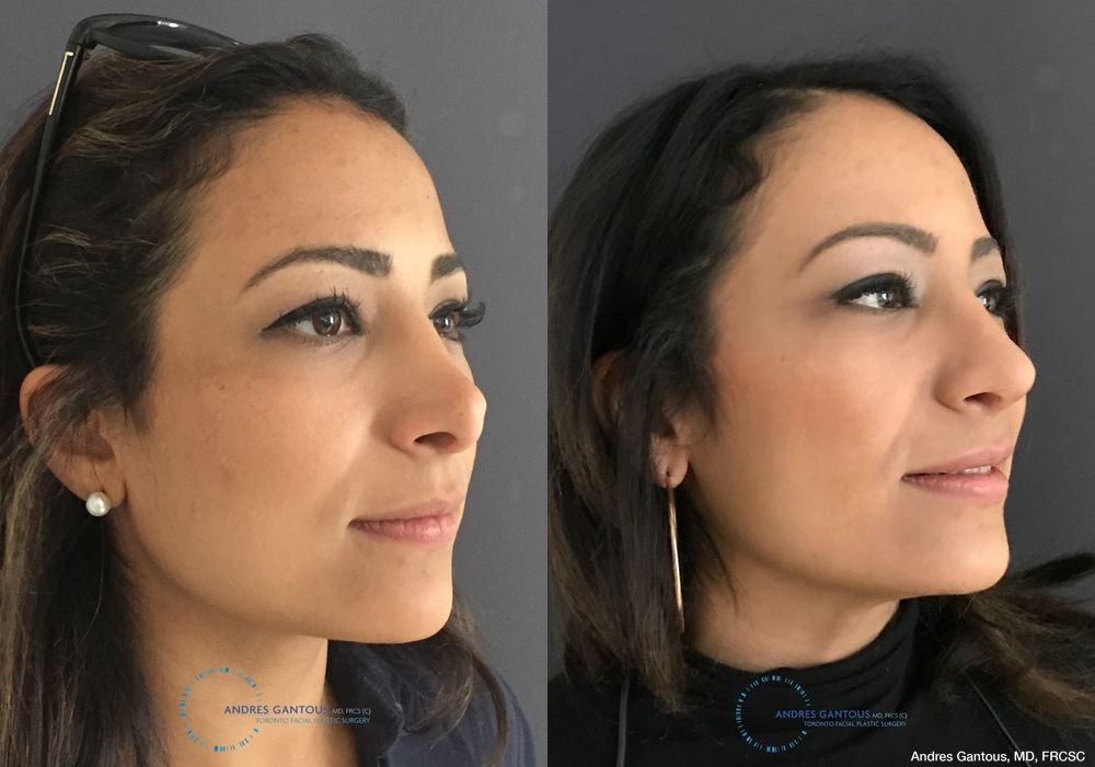 Revision Rhinoplasty - Thumbnail 3